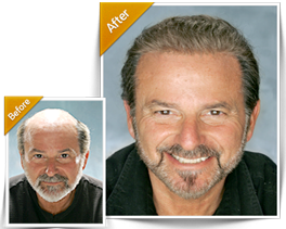 Hair Replacement for Men