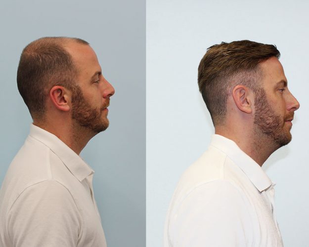 My Choice Hair Hair Replacement for Men Alex 2